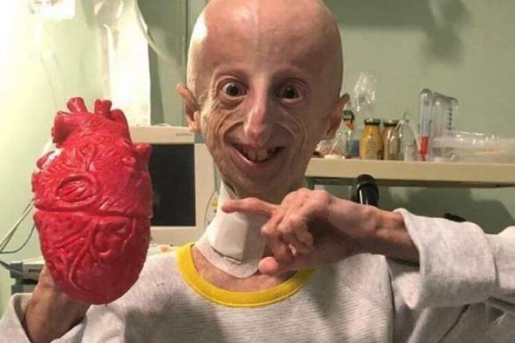 Survivor of rare rapid-ageing disease progeria dies at 28